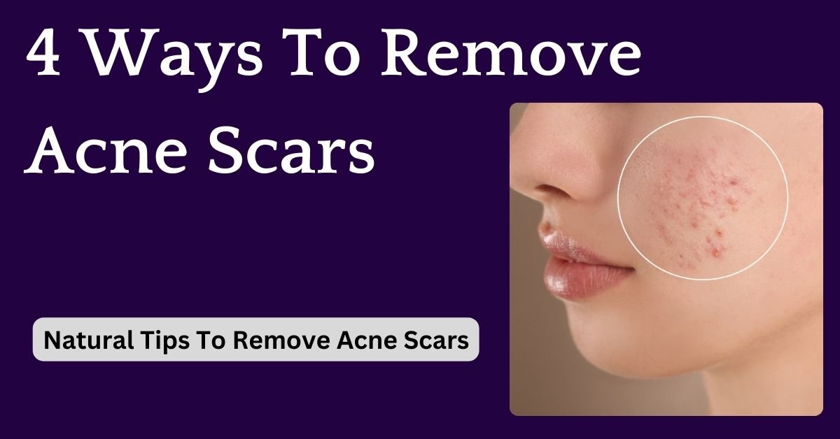 4 ways to remove acne scars